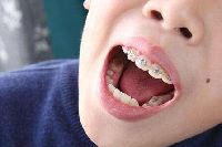 【健康解碼】矯正牙齒真的可以瘦臉嗎？